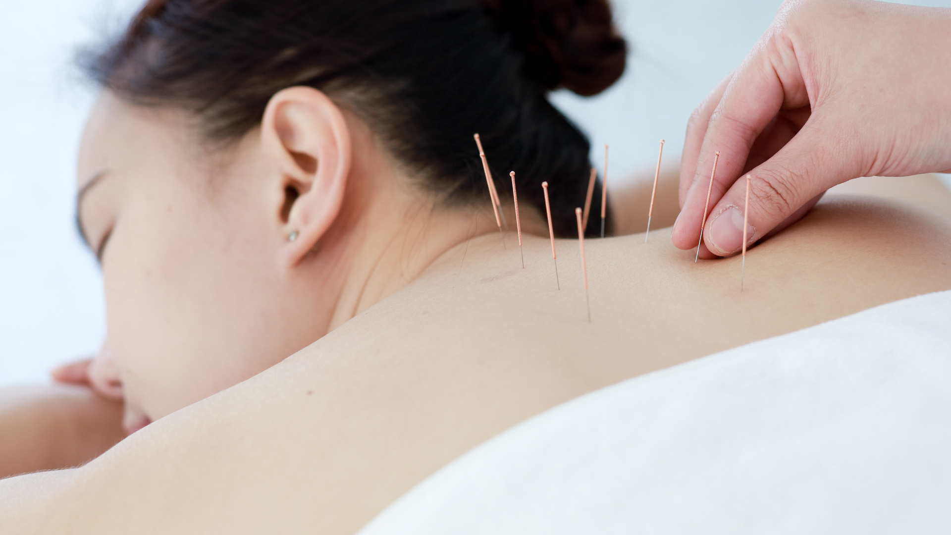 A woman is getting acupuncture on her back.