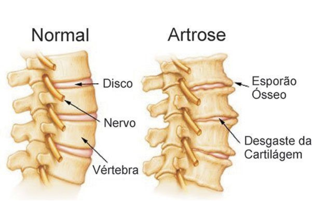 Coluna Humida Artrose na Coluna: Sintomas, Dor e Como Lidar