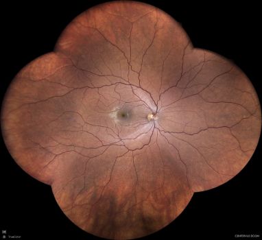 Widefield retinal image