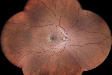 Image of the retina