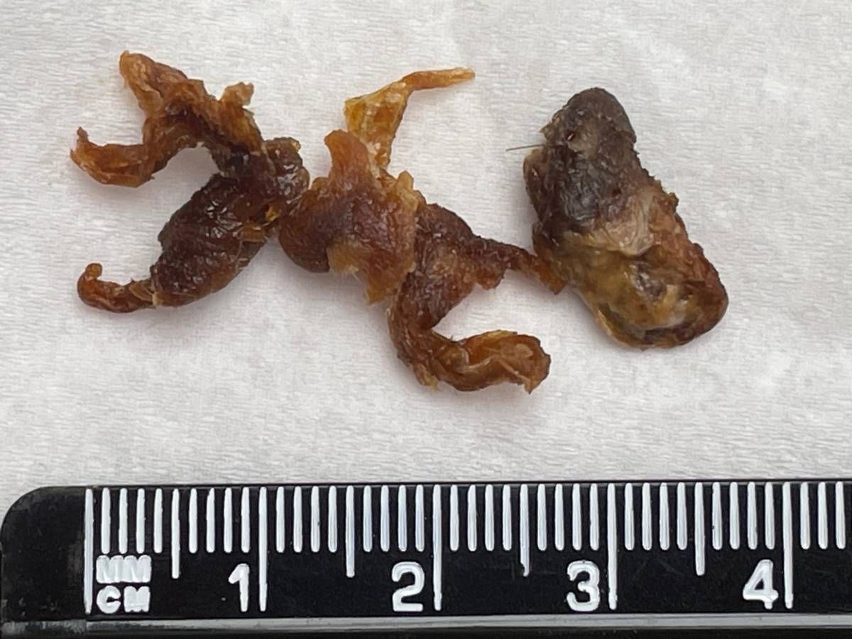 ear wax removed using irrigation