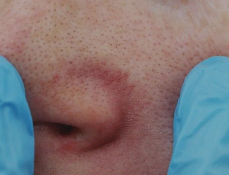 clinician inspecting shin for thread veins