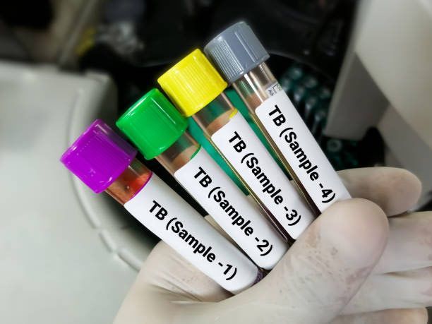 TB Testing Manteca