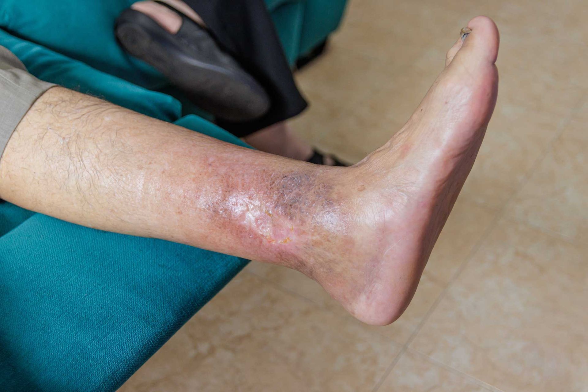 A man with an ulcer on his leg.