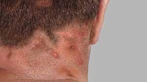 Rear view of a person's neck with several inflamed, red bumps and some hair loss.