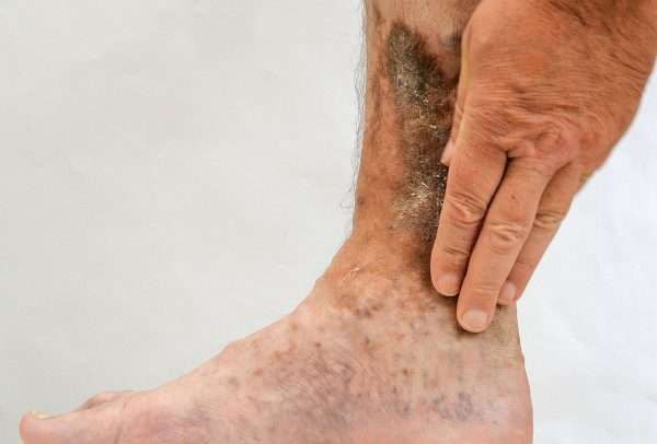 Leg with discolored skin, possibly due to a medical condition; hand touching the affected area.