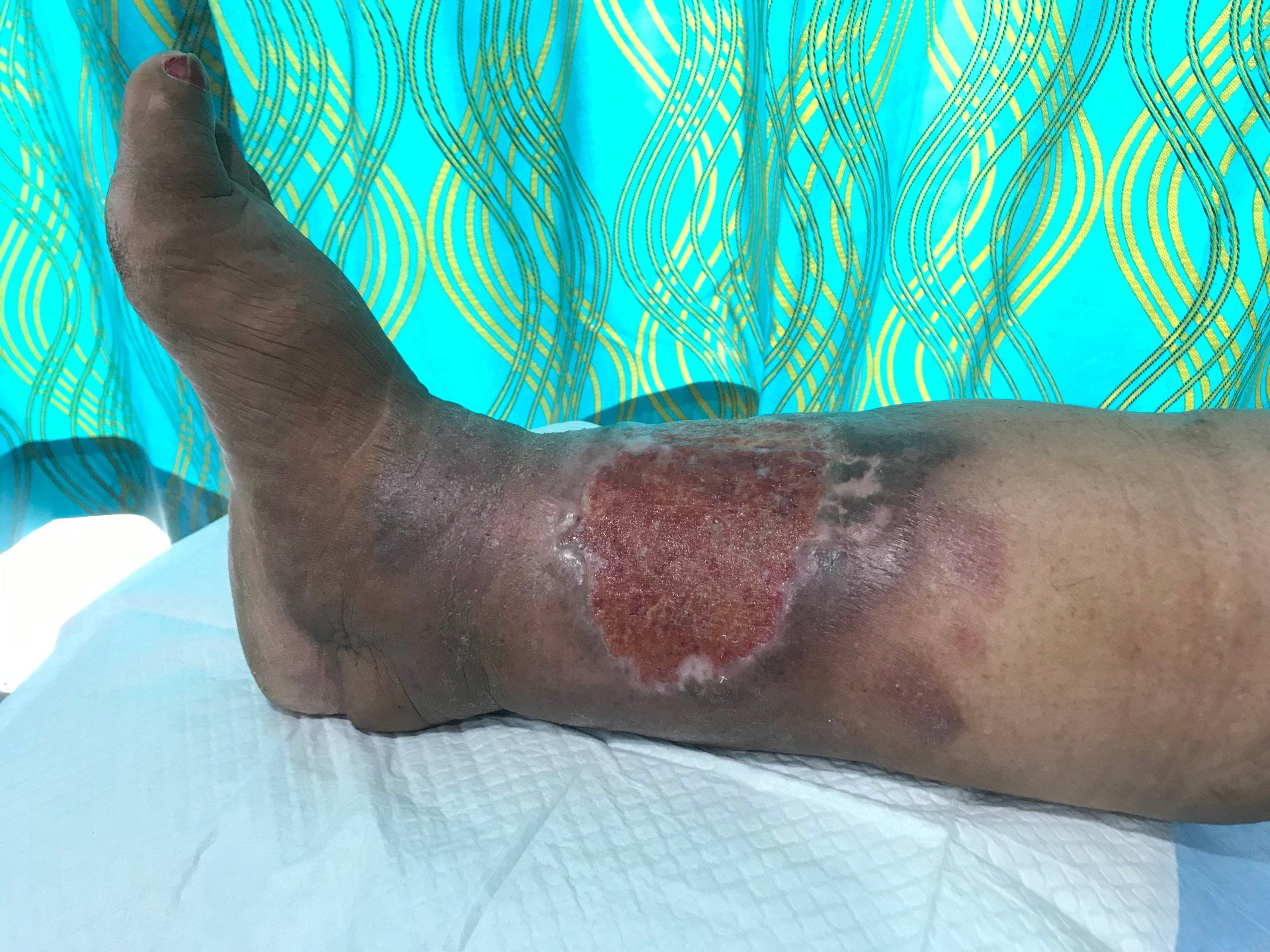 Injured Leg Treatment with Bandage — Jacksonville, FL — Wells Surgical Services LLC Injured Leg Treatment with Bandage — Jacksonville, FL — Wells Surgical Services LLC