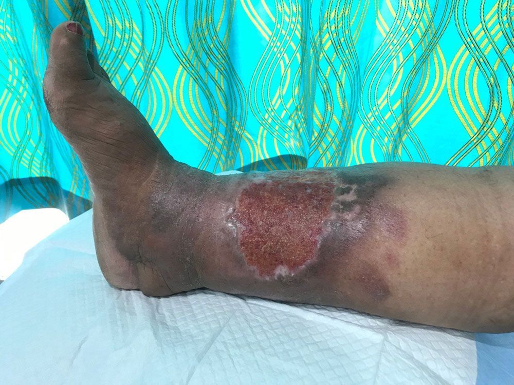 Injured Leg Treatment with Bandage — Jacksonville, FL — Wells Surgical Services LLC Injured Leg Treatment with Bandage — Jacksonville, FL — Wells Surgical Services LLC