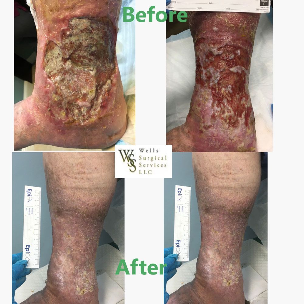 Before/After photos of a leg wound treatment. Top shows open sores, bottom shows healed skin.