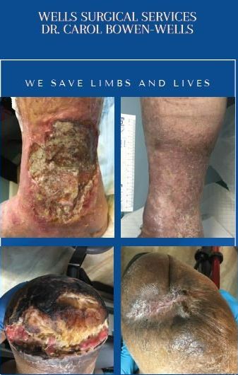 Before and after photos of leg ulcers, advertising surgical services.