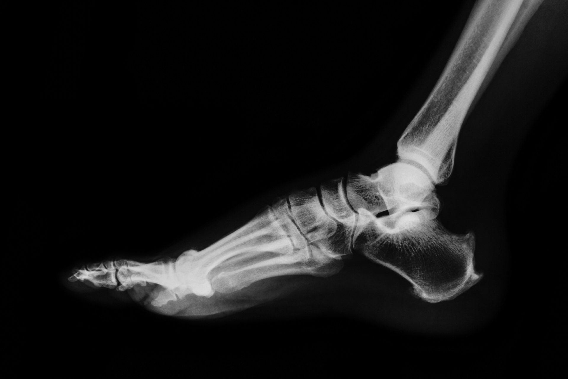Side-view X-ray of a human foot and ankle, showing bones in profile on a black background