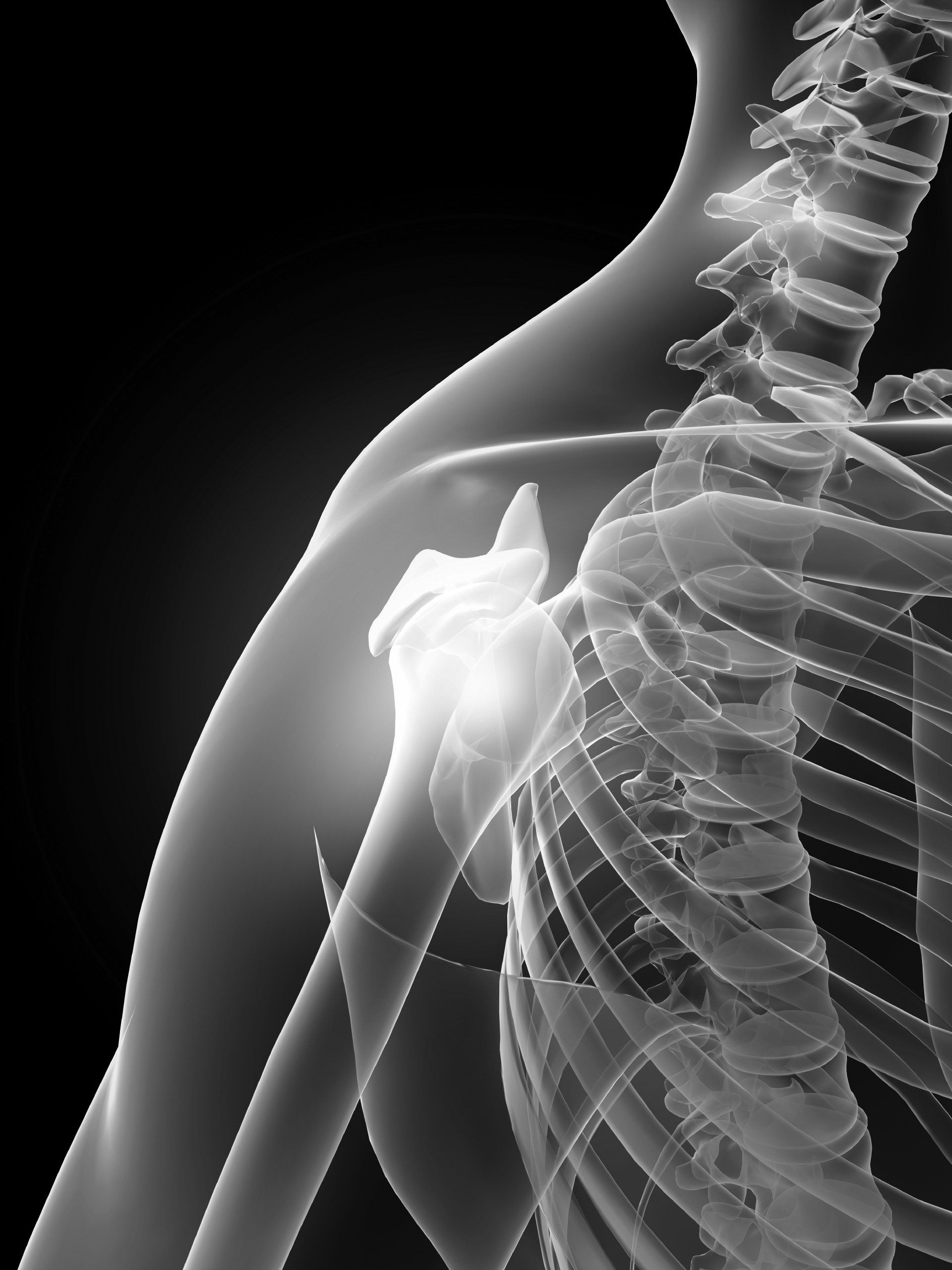 X-ray of a human shoulder and upper spine with a visible joint injury