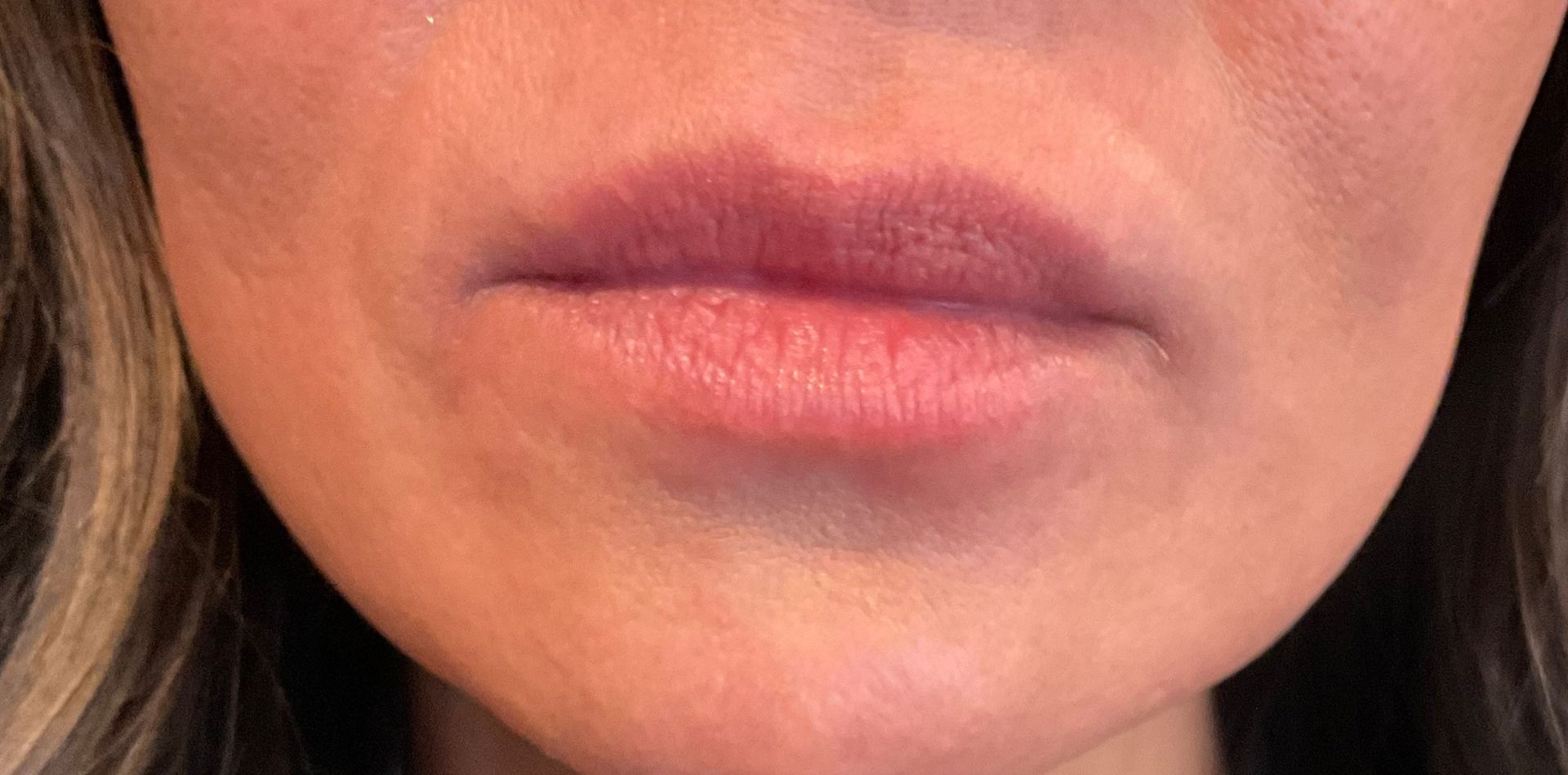Lip Filler