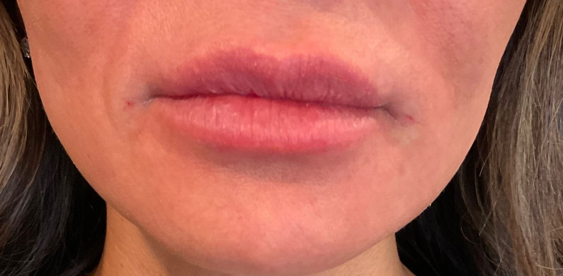 Lip Filler