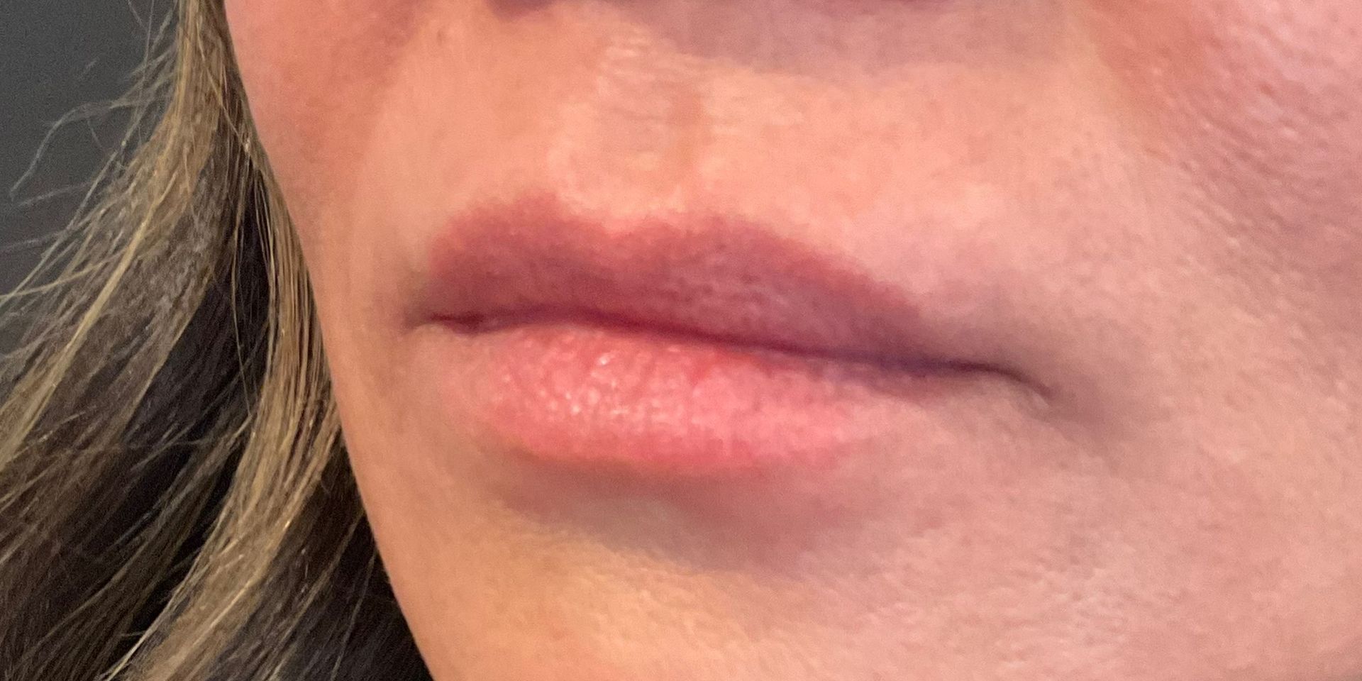 Lip Filler