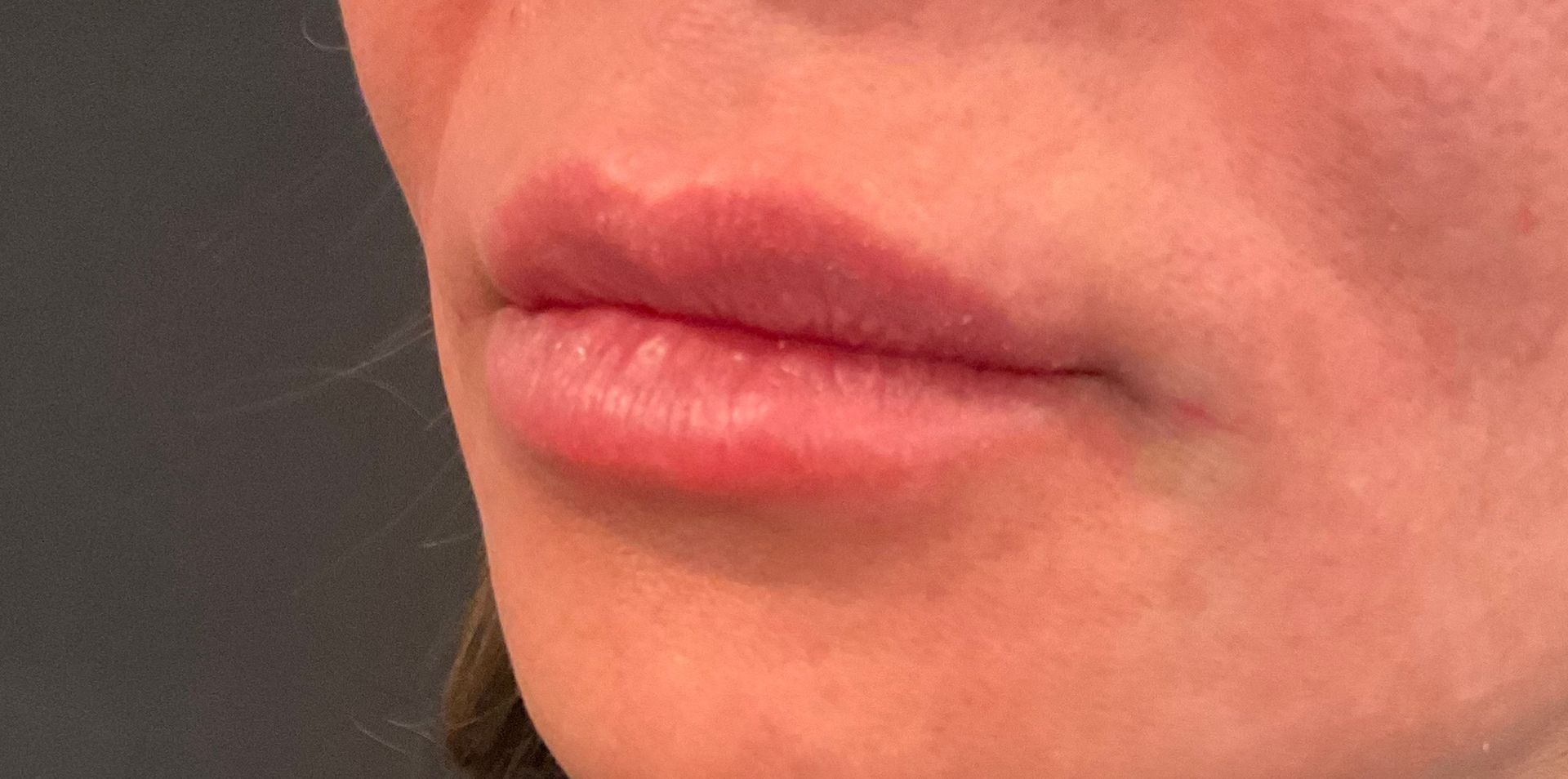 lip filler after