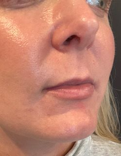 Lip Filler