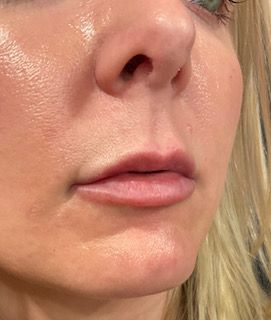 Lip Filler