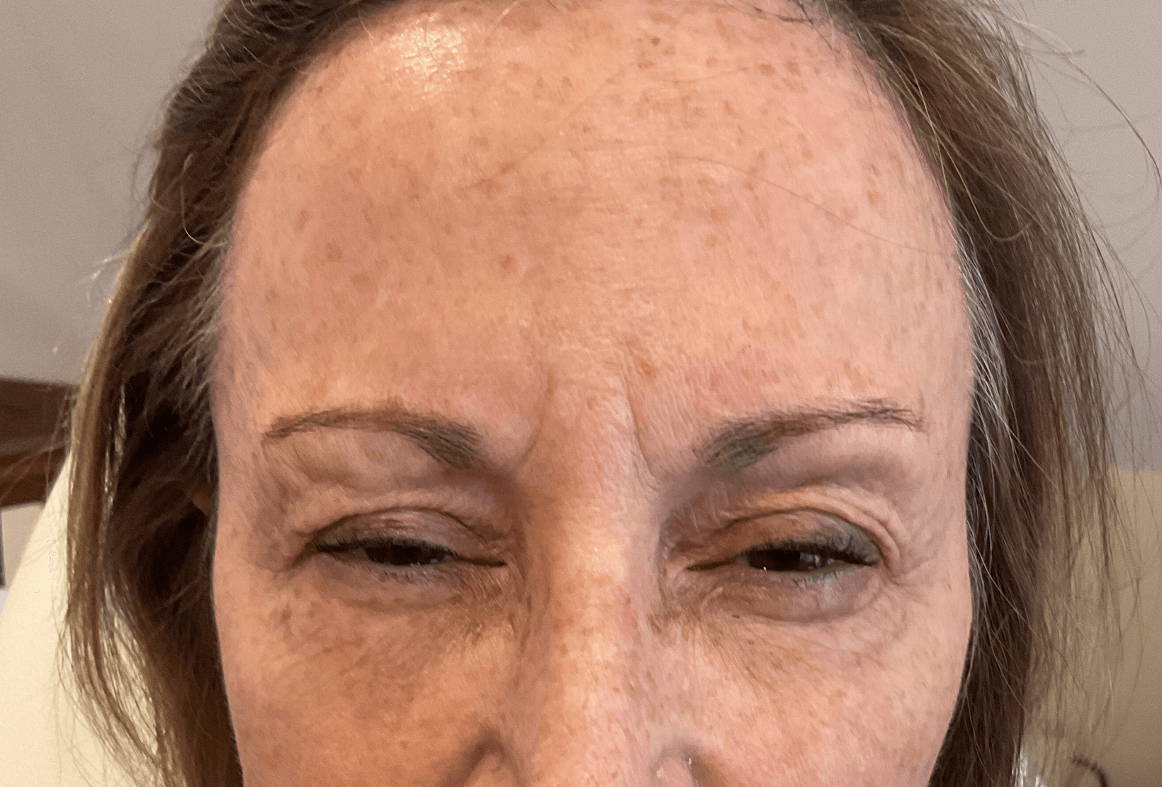 Dysport Filler