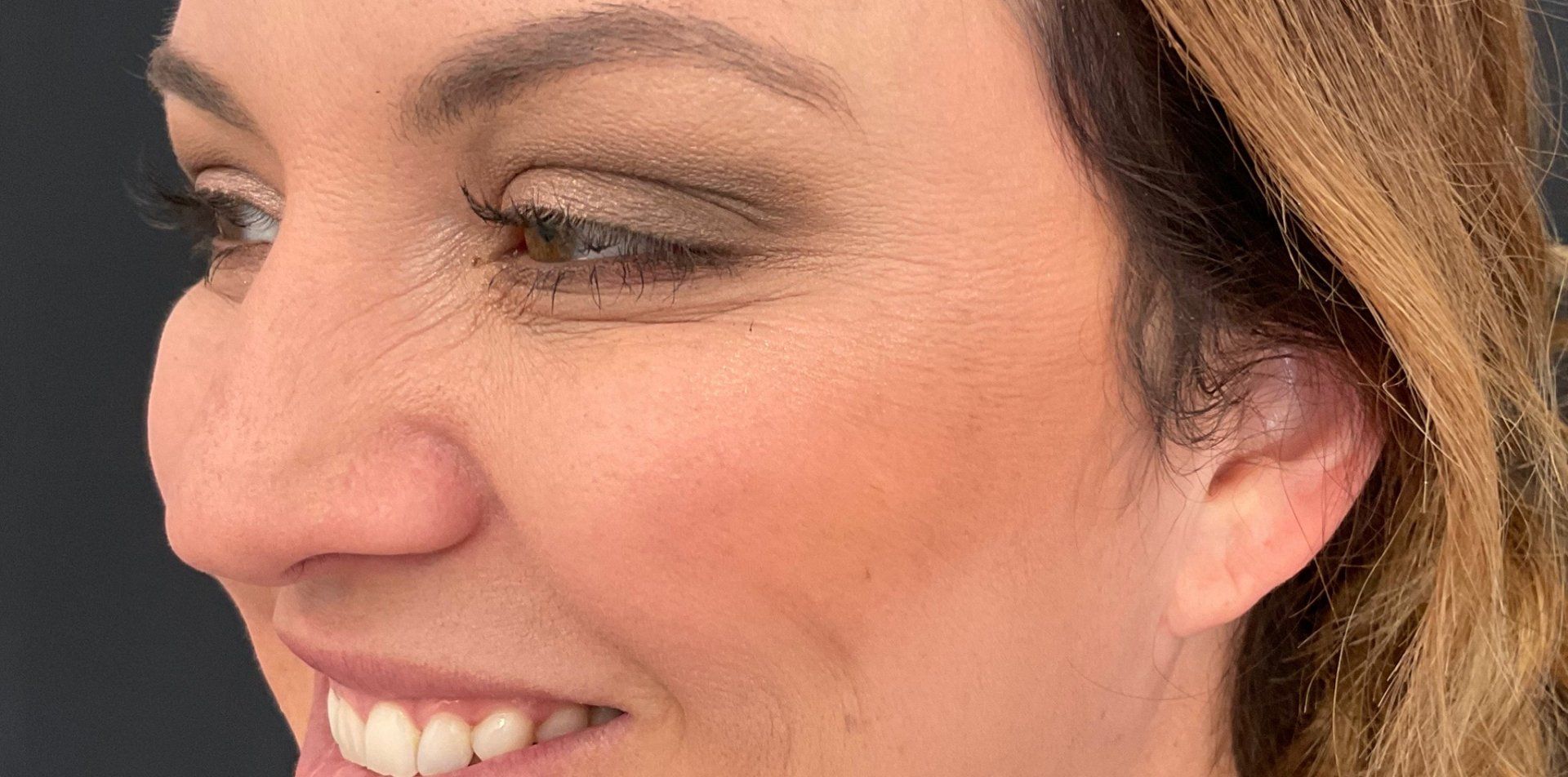 Crows feet
