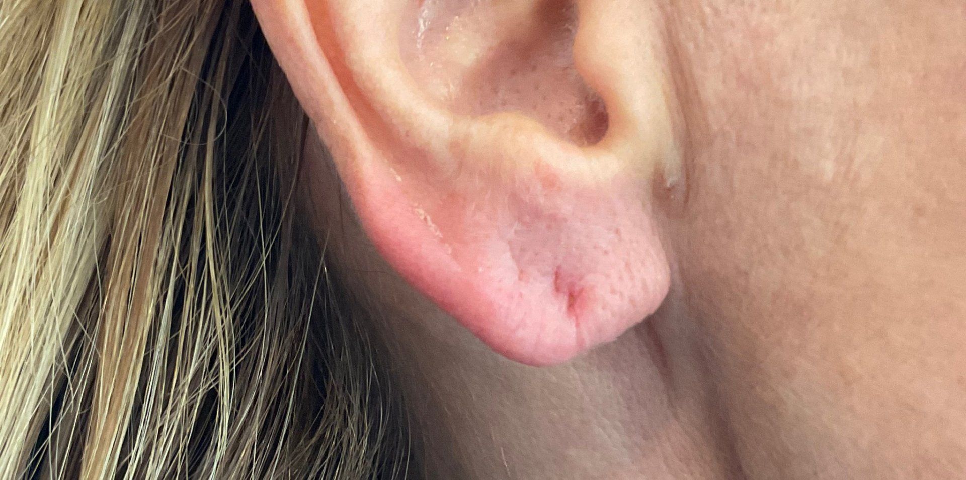 Earlobe