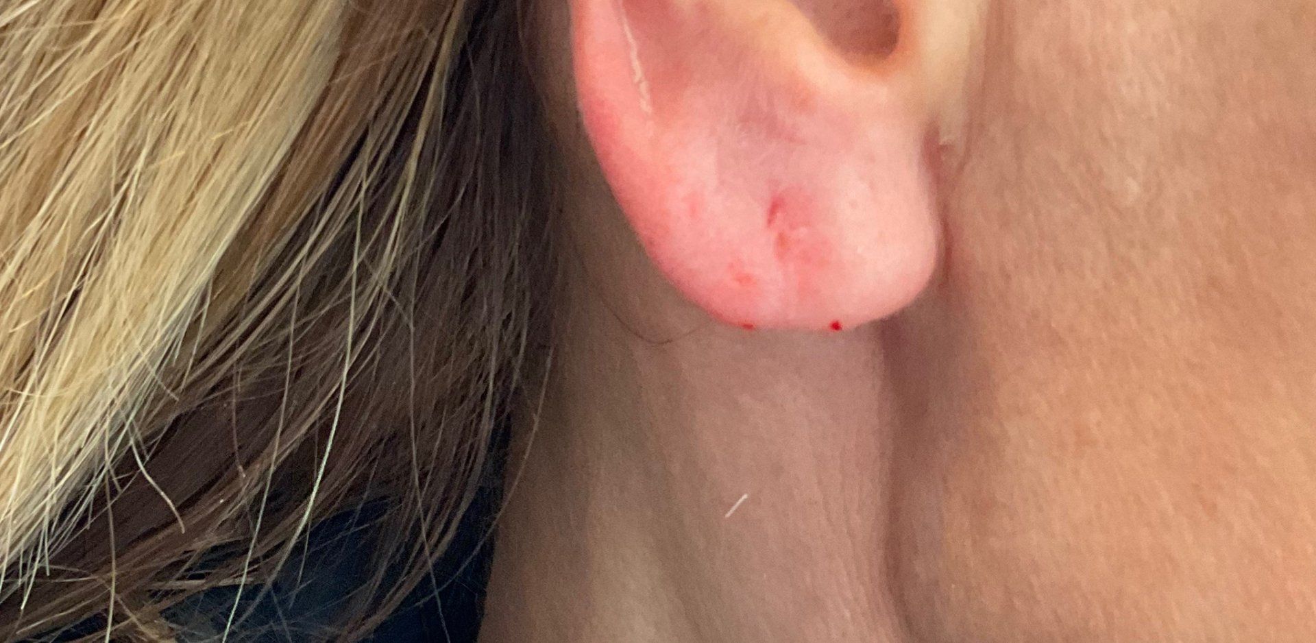 Earlobe