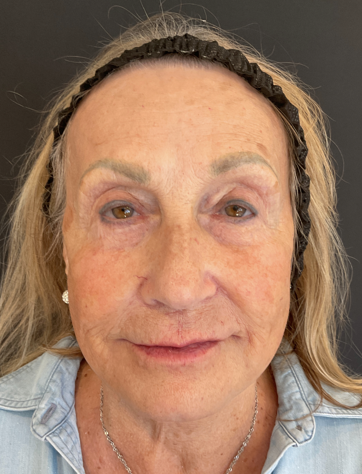 Full Face rejuvenation with Dysport® and filler