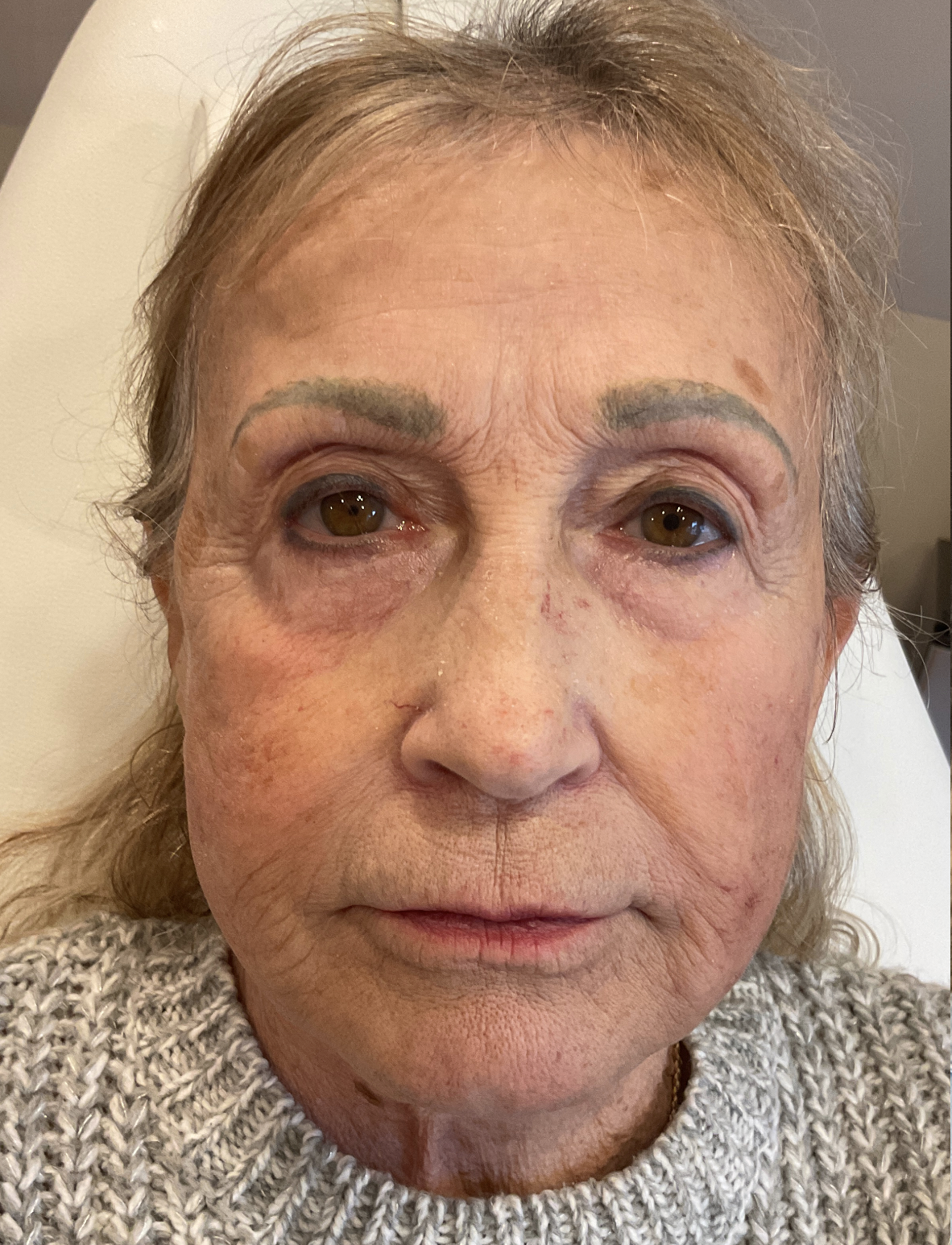 Full Face rejuvenation with Dysport® and filler