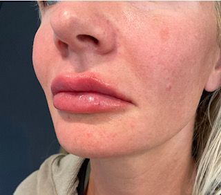 lip filler after