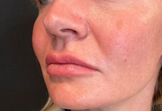 Lip Filler