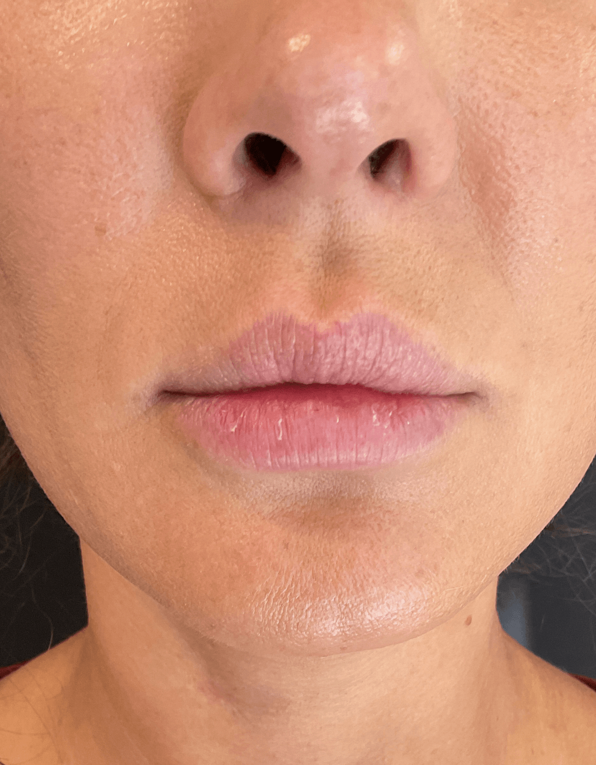 Lip Filler