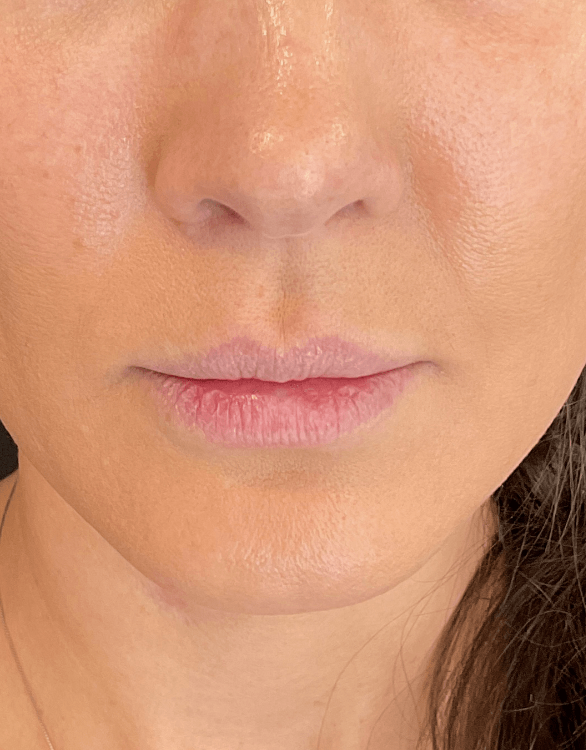 Lip Filler