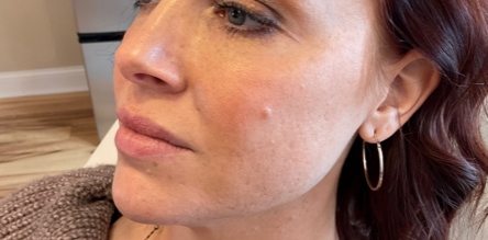 Mid-Face/Cheeks
