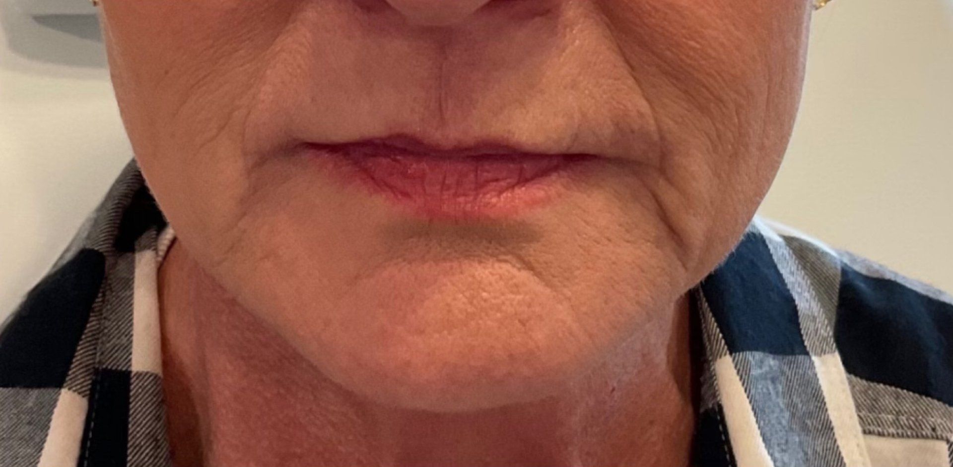 Perioral Lines