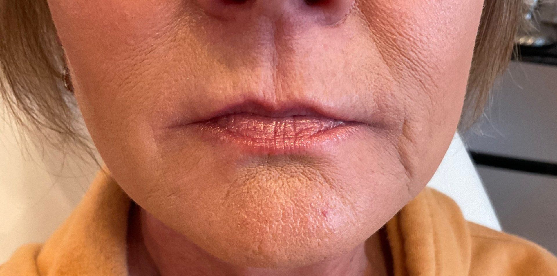 Perioral Lines
