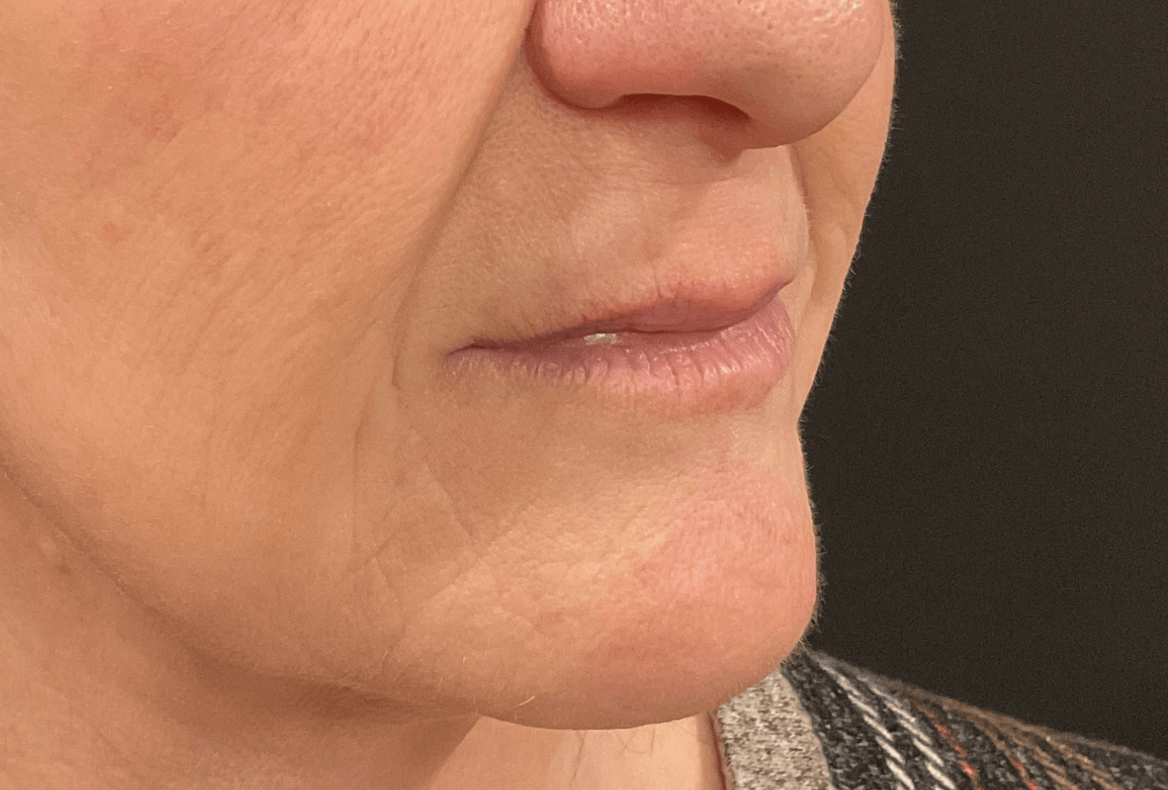 Perioral Lines