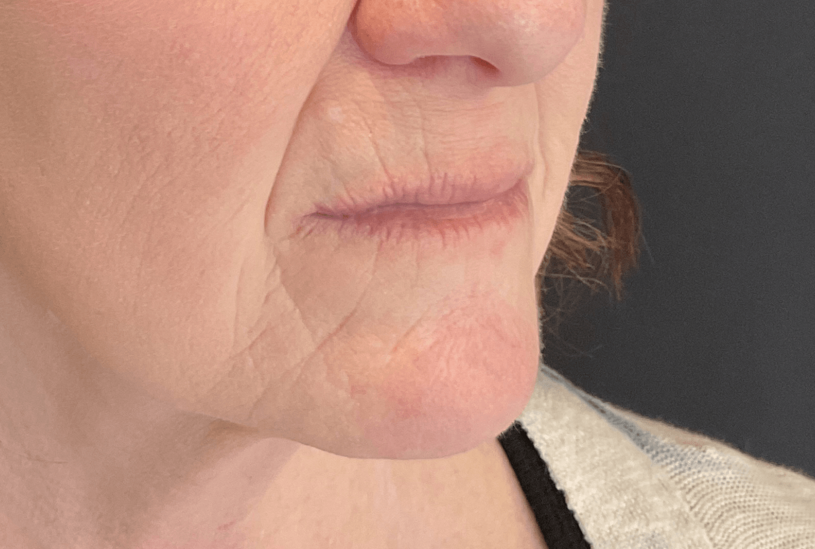 Peri Oral Lines