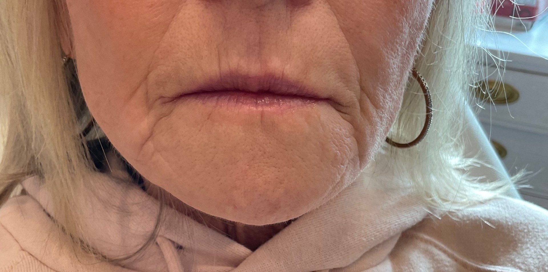 perioral Lines