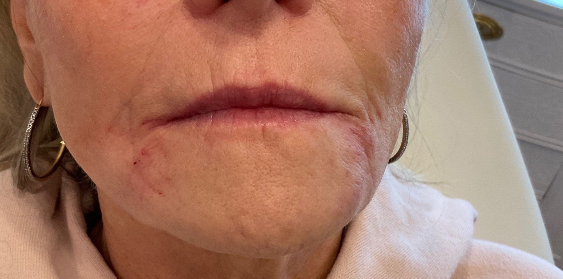 Perioral Lines