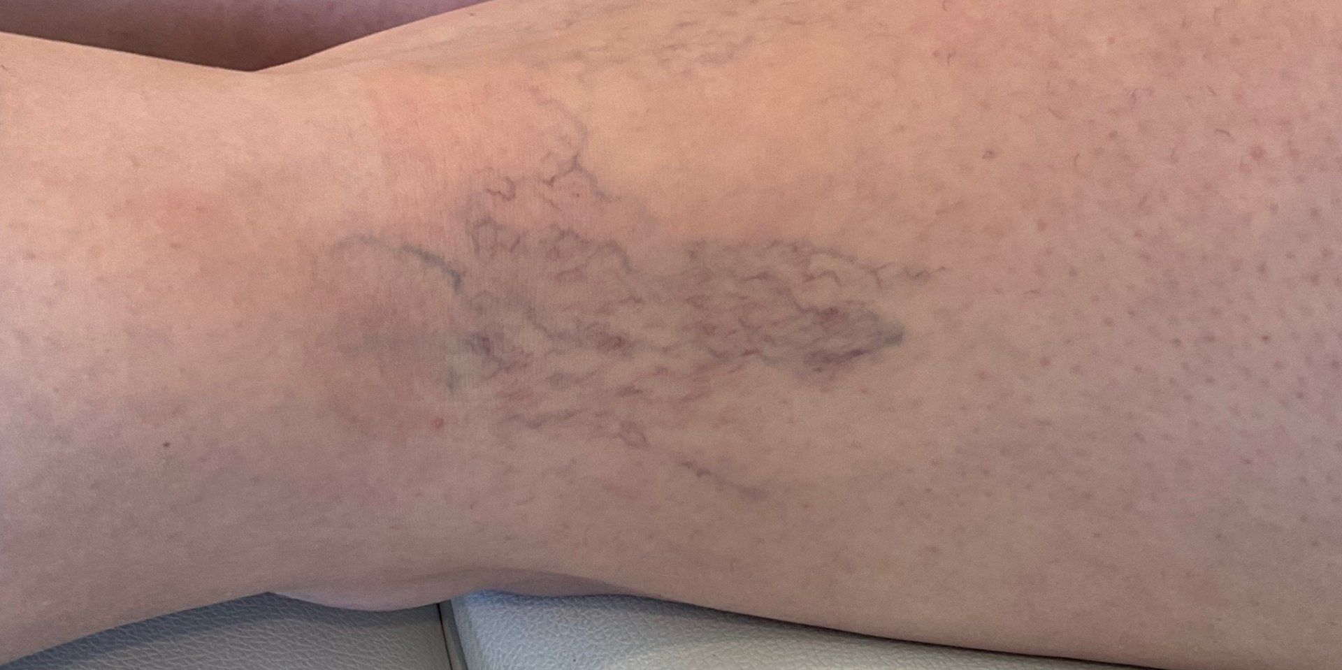 sclerotherapy