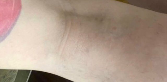 sclerotherapy