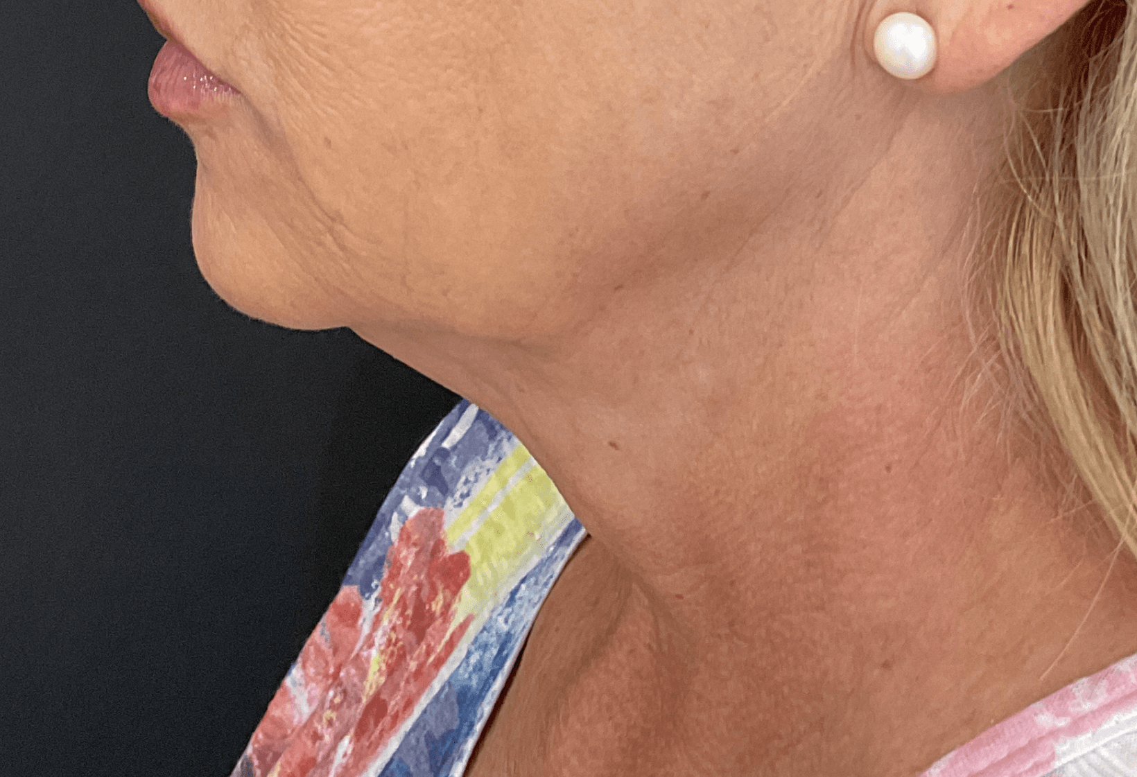 Skintyte Laser Treatment