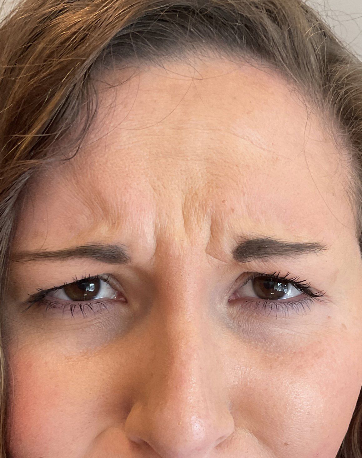 Frown Lines