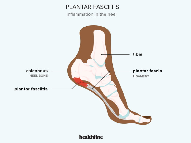 A diagram of plantar fasciitis inflammation in the heel.