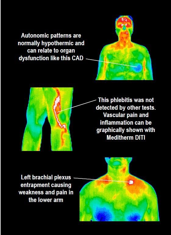 A thermal image of a person 's body showing various areas of pain