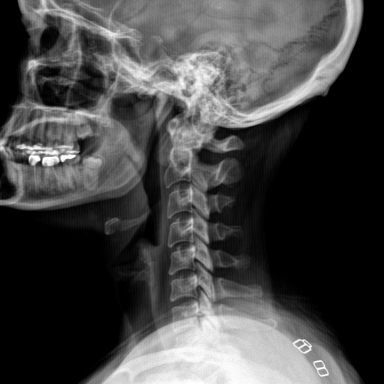A black and white x-ray of a skull and neck.