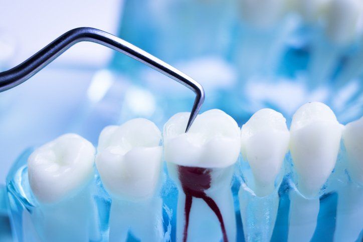 root canal