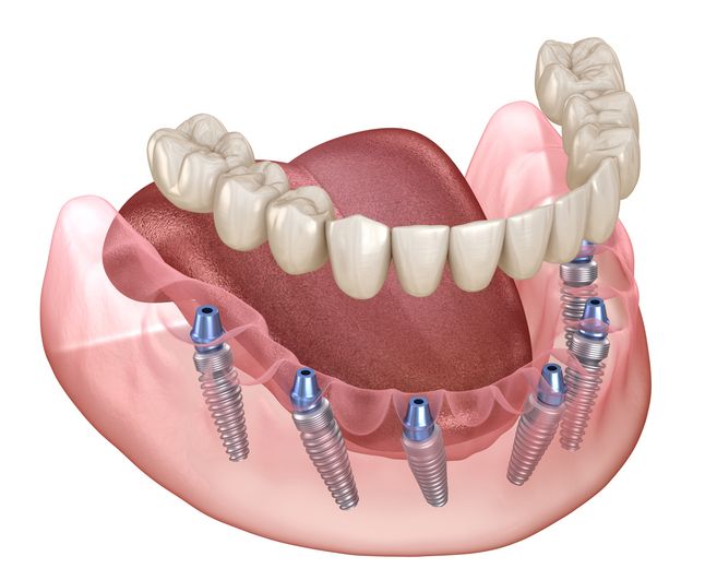 Lower jaw dental implant bridge with screws and attached teeth on a pink gum model