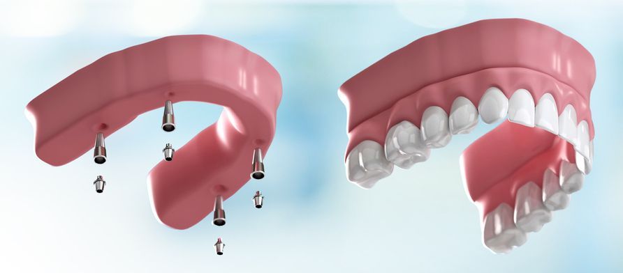 Pink removable dental appliance with embedded tooth brushes and cleaned teeth illustration
