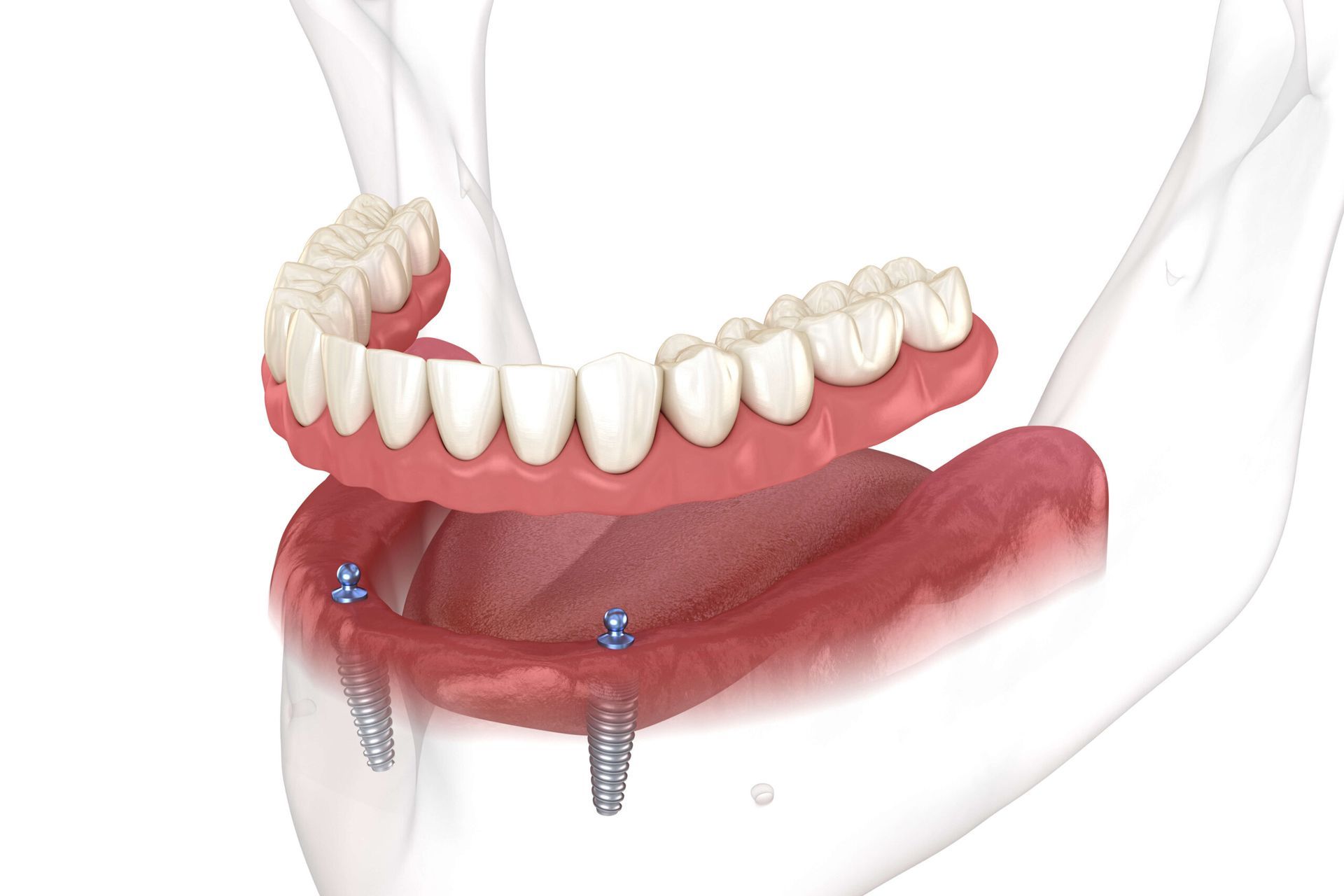 3D dental implant model of a lower jaw with two metal implants and artificial gums
